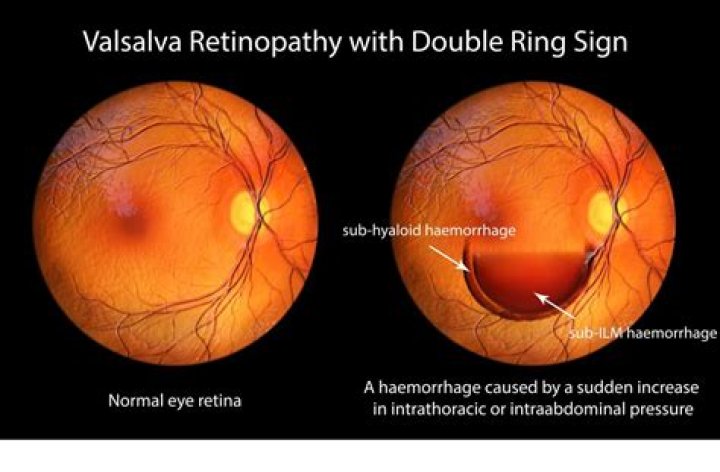 Valsalva Retinopathy: Causes, Symptoms and Treatment