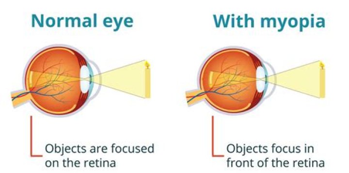 What Are Myopia (short-sightedness) and Myopia Progression?