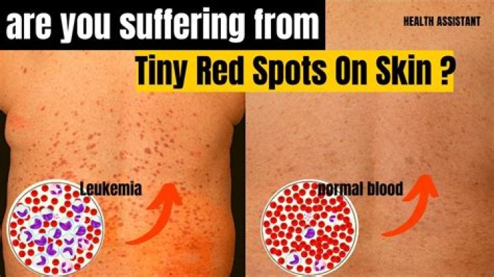 What do Leukemia red spots look like?