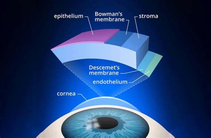 What Is a Corneal Descemetocele?