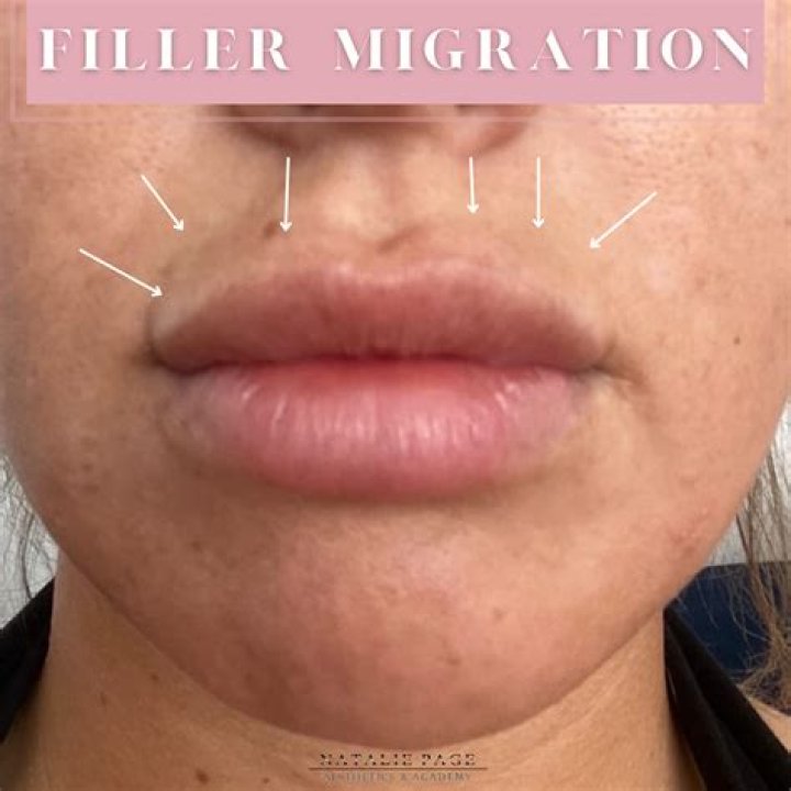 What Is Filler Migration and How You Can Treat It