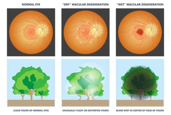 What is Myopic Macular Degeneration (MMD)?