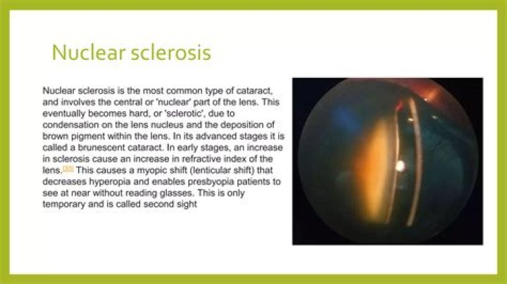 What is Nuclear Sclerosis? - All About Vision