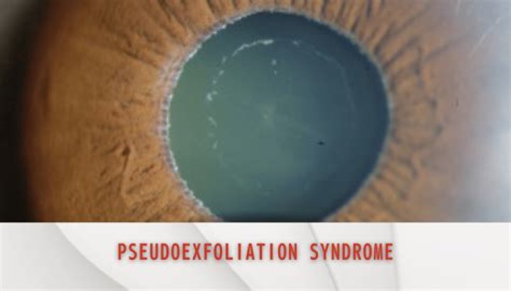 What Is Pseudoexfoliation Syndrome in the Eye?