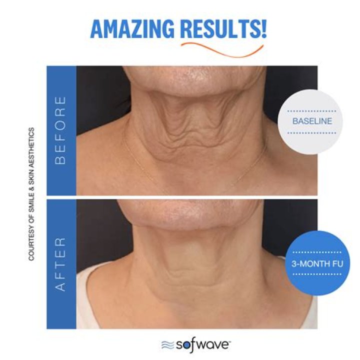 What to Know About Sofwave Skin Tightening Treatment