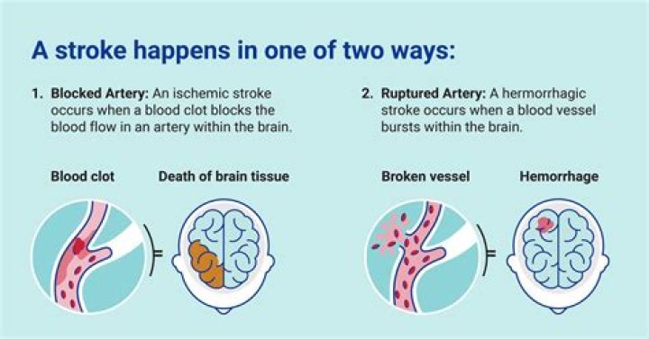When Did Harry Connick Jr Have A Stroke? Understanding His Health Journey