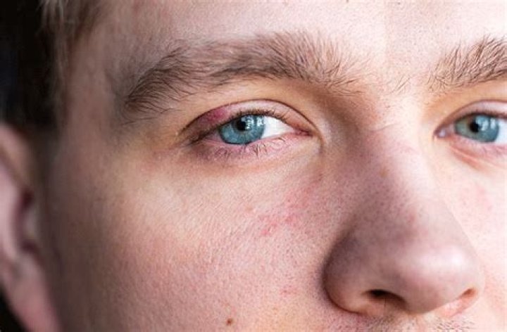 Which Medications Treat Styes?
