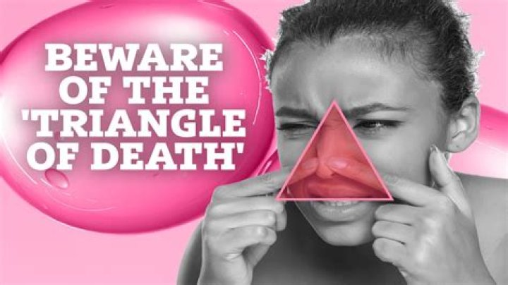 Why Popping Pimples In The Triangle Of Death Is Dangerous