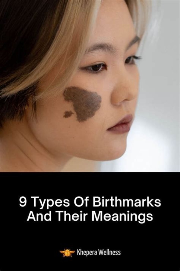 Woman Born With Birthmarks All Over Her Body Is Our Hero